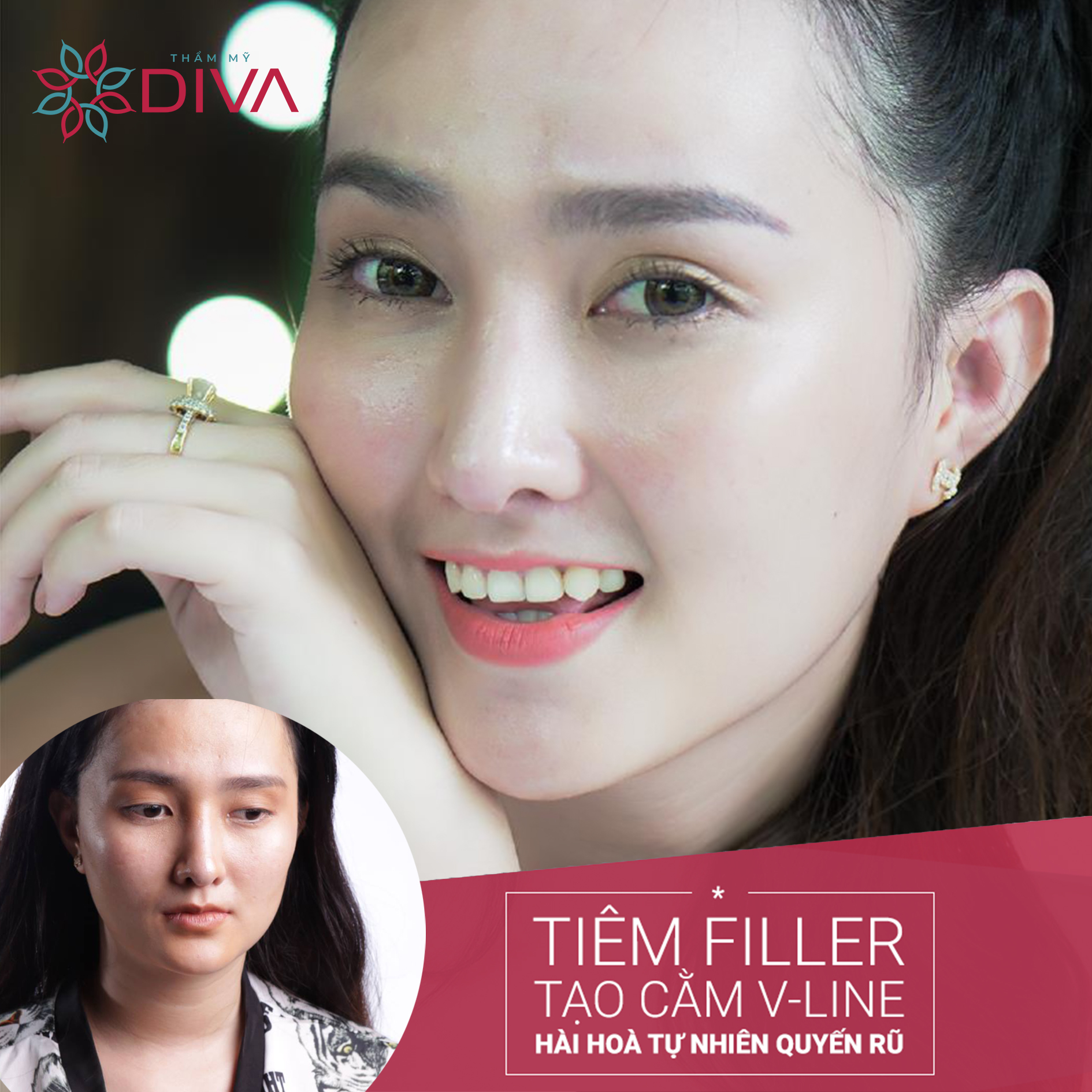 Tiêm Filler cằm – Giải pháp cho khuôn mặt ngắn, cằm lẹm