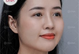 NÂNG MŨI Ở ĐÂU AN TOÀN? CÁC PHƯƠNG PHÁP NÂNG MŨI ĐẸP TỰ NHIÊN