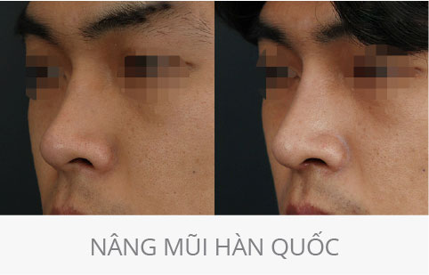 hình ảnh trước và sau thẩm mỹ mũi