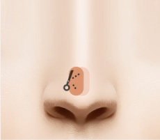 Rạch đường mỗ nhỏ bên trong lỗ mũi. Bóc tách da ở phía trên sụn đầu mũi