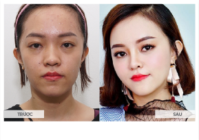 ảnh trước và sau khi phẫu thuật