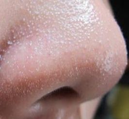 Phương pháp trị mụn cám cho mặt hiệu quả