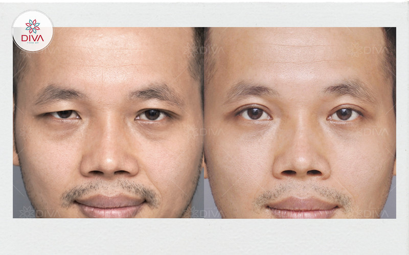 Hình ảnh khách hàng: Kết quả cắt mí mắt cải thiện tình trạng mí sụp