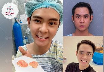 Giảm mỡ má có đau có để lại sẹo không?