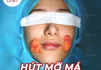 Thẩm mỹ hút mỡ má có hiệu quả không?