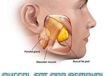 Buccal Fat Pad Removal là gì? Có giống hút mỡ mặt không?