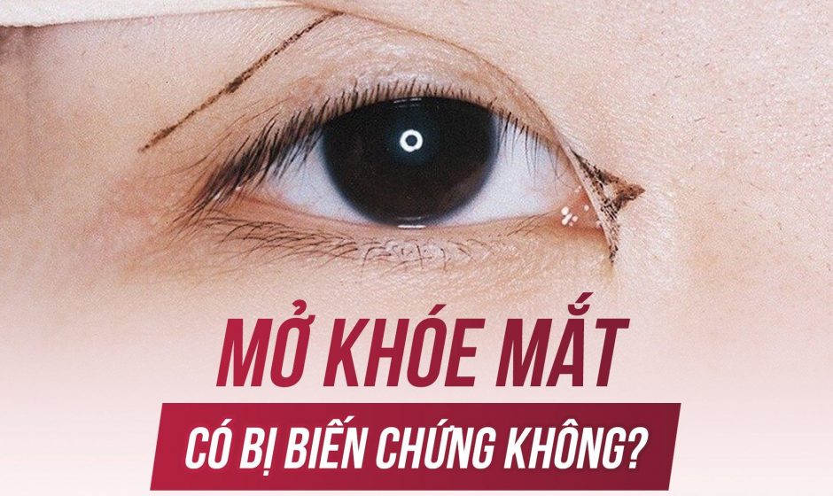 Mở khóe mắt có bị biến chứng không?