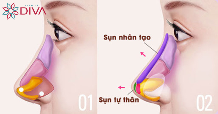 Nâng mũi cấu trúc kết hợp giữa sụn nhân tạo và sụn , đồng thời thu gọn, làm đẹp đầu mũi. 