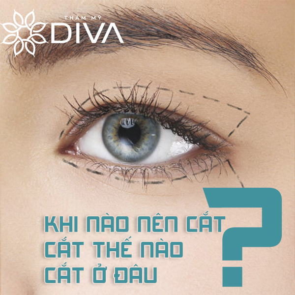 review cắt mí mắt tại thẩm mỹ DIVA