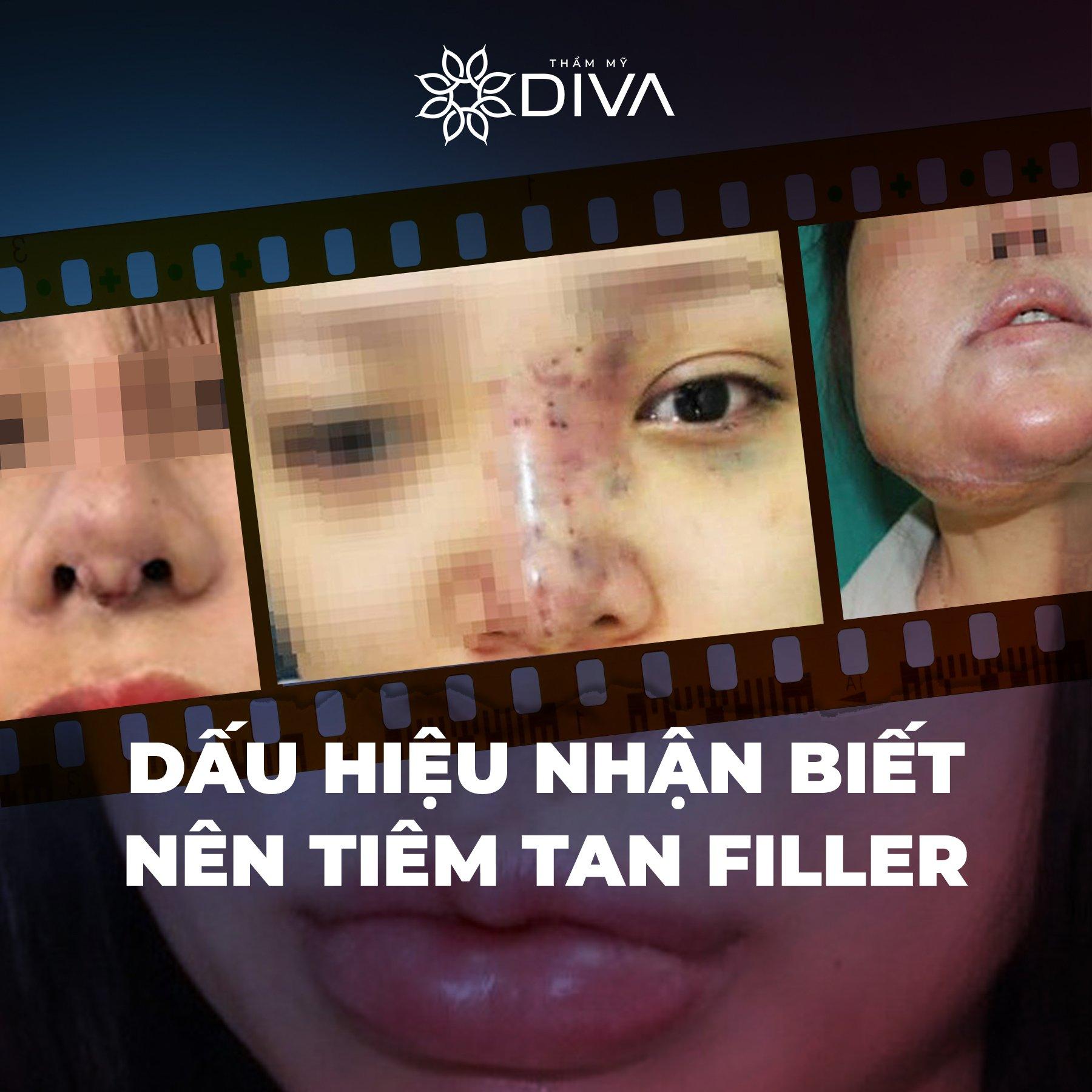 Tiêm Tan Filler Bị Tím: Nguyên Nhân và Giải Pháp Hiệu Quả