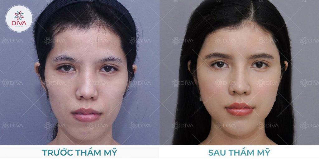 Hình ảnh khách hàng sau khi cấy mỡ mặt tại Thẩm mỹ DIVA