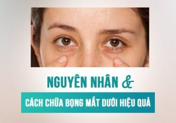 Nguyên nhân và cách chữa bọng mắt dưới hiệu quả
