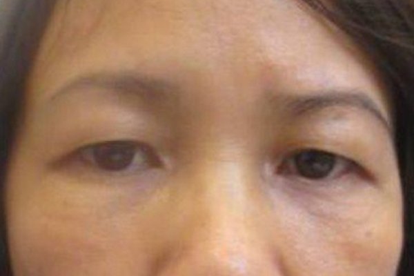 Nguyên nhân gây tình trạng mắt cụp có thể là do bẩm sinh, bị dư da mí mắt hoặc do các nhóm cơ quanh mắt