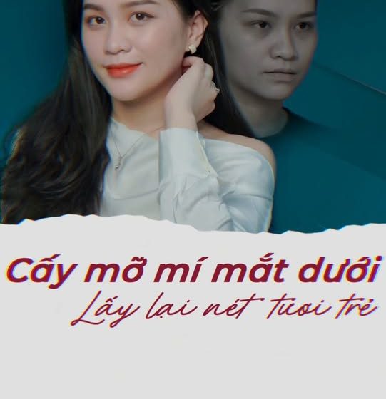 Cấy mỡ khuyết lõm dưới mắt – lấy lại nét tươi trẻ